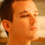 Ben Carver after last weekend's attack in New York. (Photo courtesy of Ben Carver)